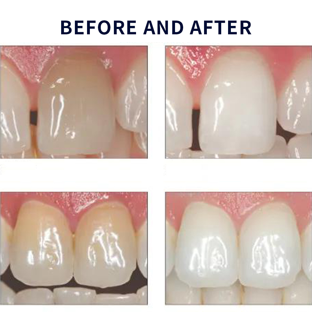 Opalescence Whitening 20% PF 2 - Teeth Whitening Gel review and price