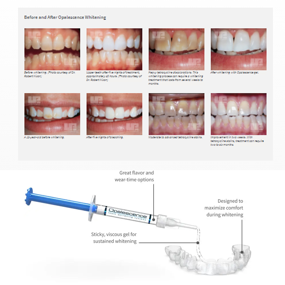 Opalescence Whitening 20% PF 2 - Teeth Whitening Gel review and price