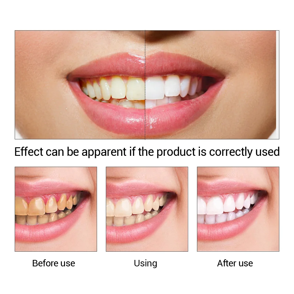 FTEENPLY Teeth Whitening Essen - Teeth Whitening Remedies review and price