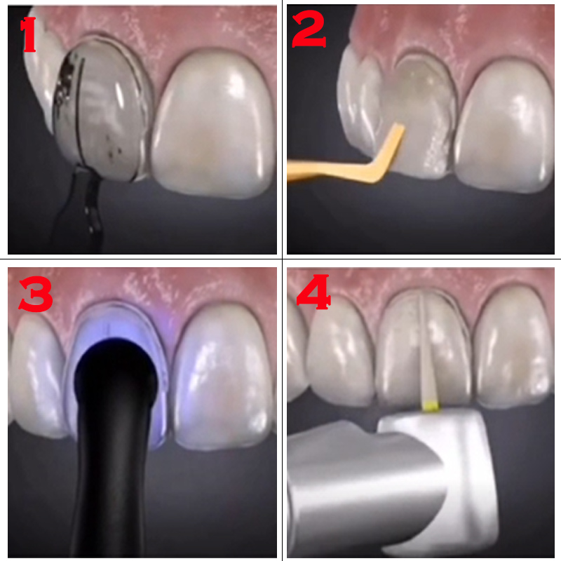 Dental Mold for Composite Resi - Teeth Whitening Lab review and price