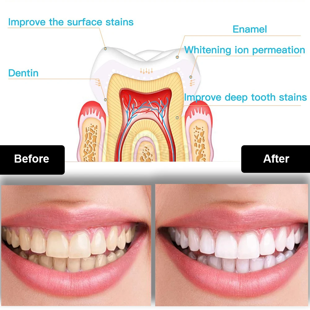 Dental Teeth Whitening Kit Min - Teeth Whitening Gel review and price